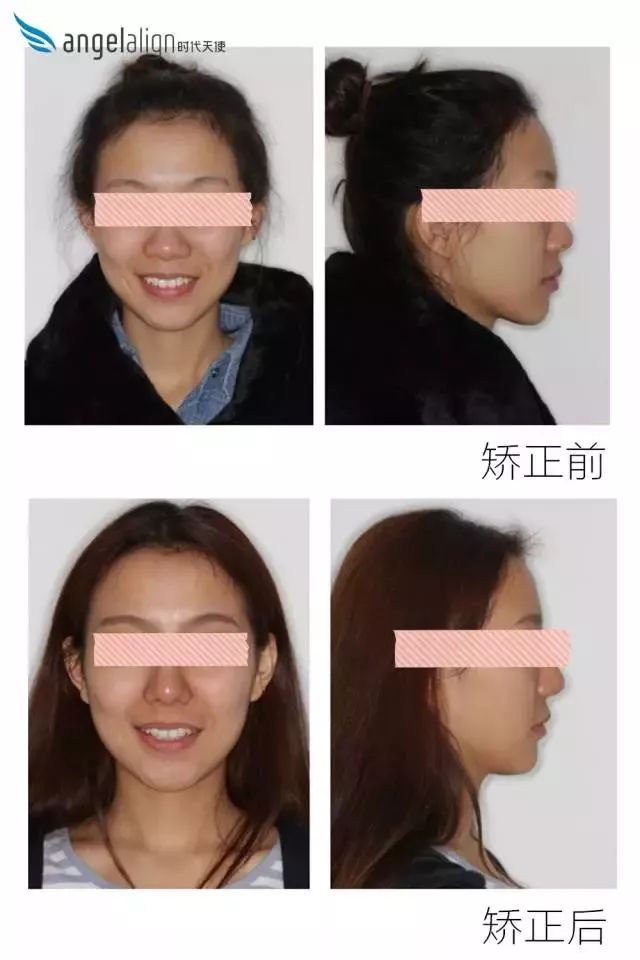 正畸主治学习视频,正畸钟摆效应名词解释