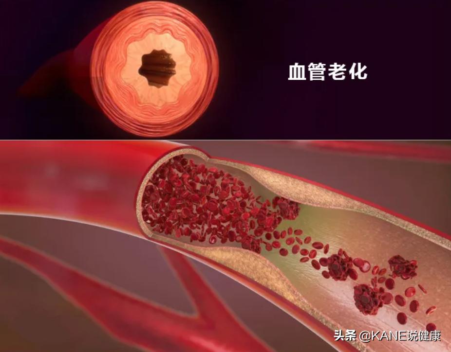 血液净化能控制血栓吗,血液净化真的能排油吗