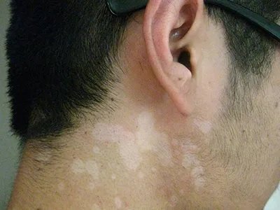 不是所有白斑都是白癜风,是不是所有的白斑都是白癜风