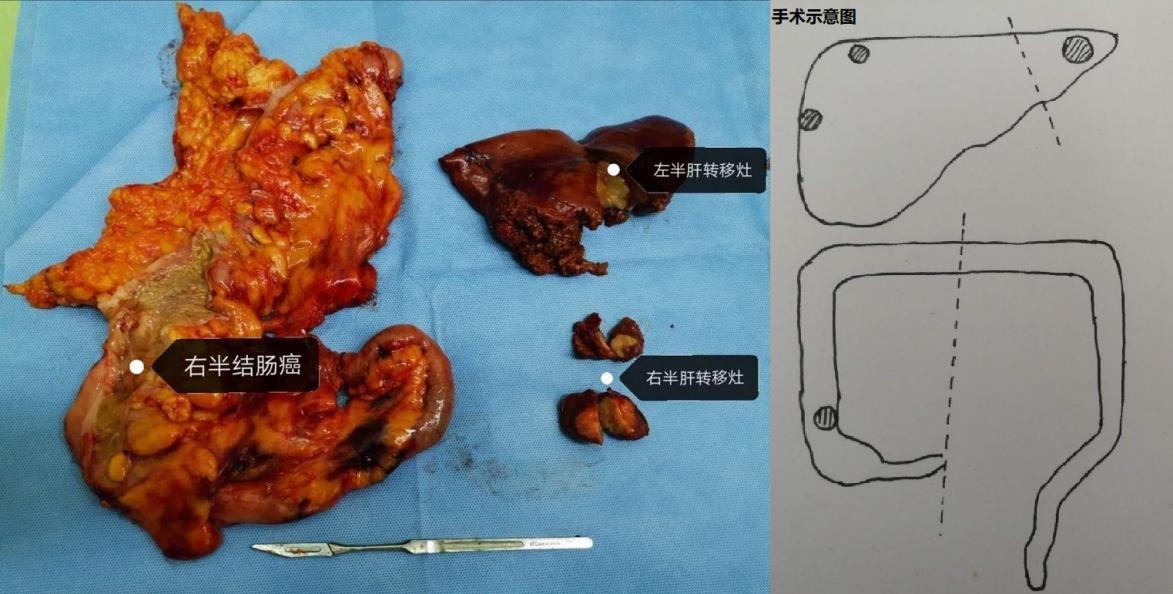 哈尔滨肿瘤医院结直肠癌专家,哈医大二院切胃手术