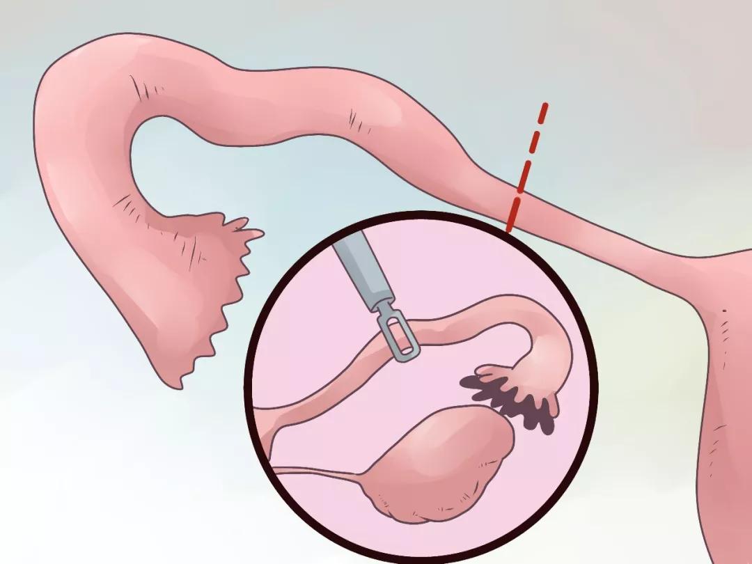 不知道怀孕了怎么避免宫外孕,受孕了怎么才知道有没有宫外孕
