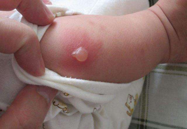 1岁宝宝脚上长了一个透明水泡,1岁宝宝脚上起水泡