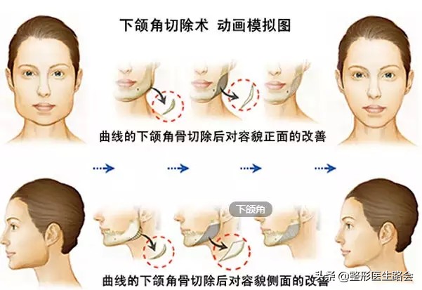 下颌角整形│对不起,你的脸让我的心好“方”
