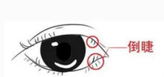 结膜炎流眼泪用眼药水没用怎么办,结膜炎眼睛流眼泪严重用什么药水