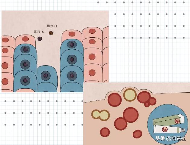 羞羞后警惕HPV感染,一不小心会得宫颈癌