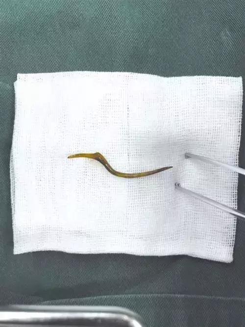 女子吃烧烤喉咙疼,吃完火锅喉咙痛10分钟女子抢救