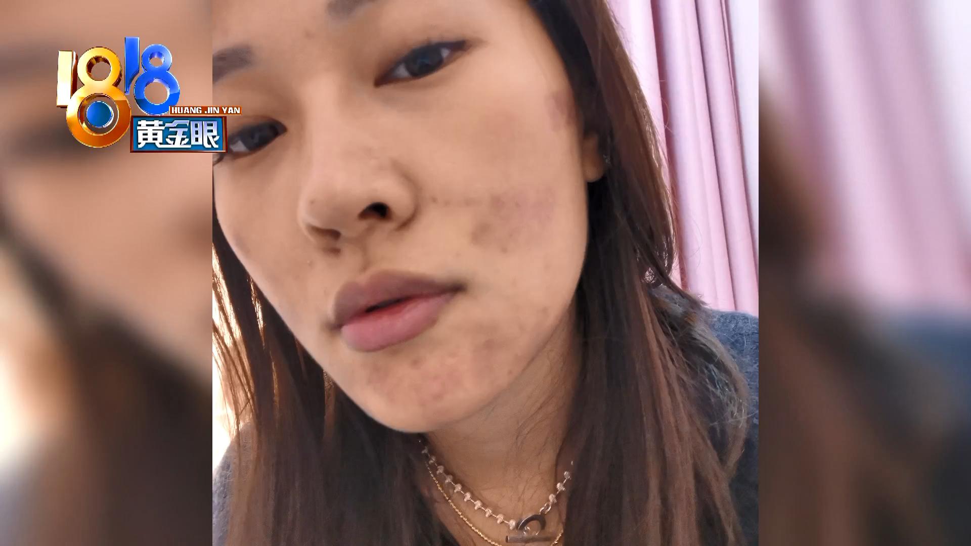 脸上有个黑色痘印一直反复结痂,脸上痘印周围红红的像结痂一样