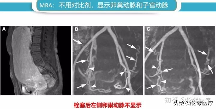 卵巢肿瘤核磁共振能看出来吗,超声测出来肿瘤