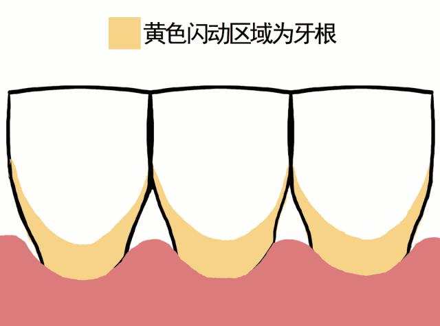 口臭刷牙牙龈出血是什么原因,刷牙流血口臭算不算重度牙周炎