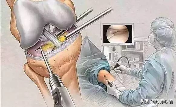 关节积液是不是不能治断根,关节积液如何做到不复发