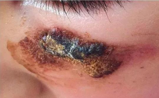 皮肤过敏抹芦荟胶有用吗,皮肤瘙痒抹芦荟胶可以吗