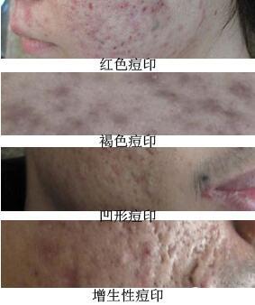 比较深的痘印怎么消除,坑坑洼洼的痘印红血丝怎么消除