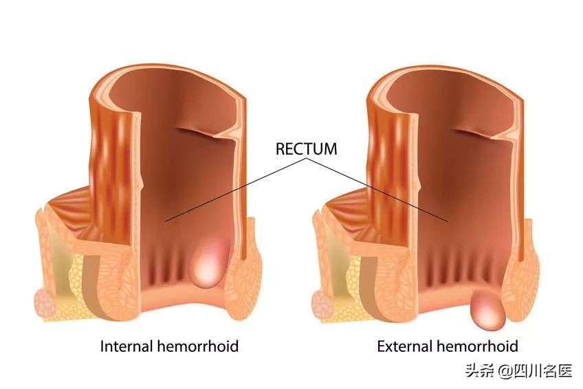 人为什么会长痔疮什么原因导致的,你为什么会长痔疮
