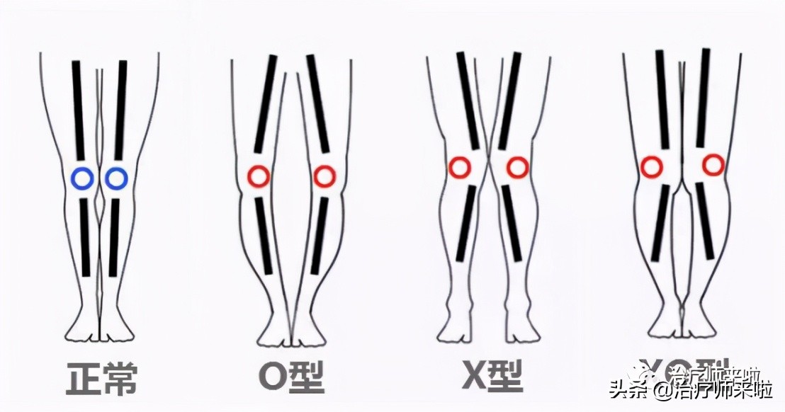 怎么让腿型改正,怎样使腿型变直