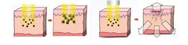 激光美白建议做吗,对激光还有哪些了解