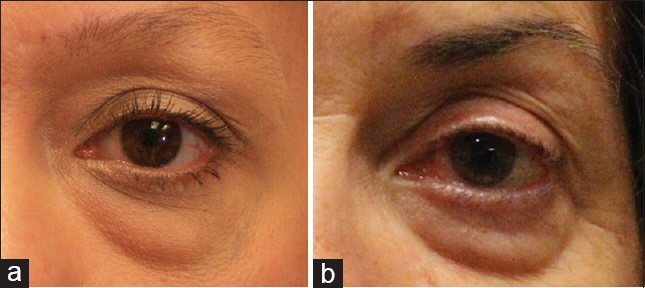 宝宝眼睛一圈黑眼圈是怎么回事,宝宝眼下黑眼圈很重是什么原因