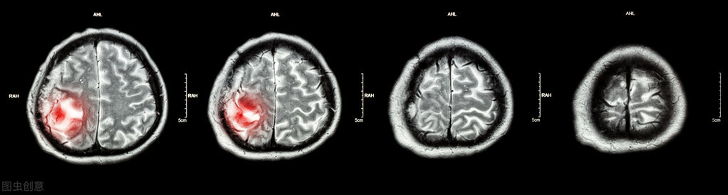 脑子里长瘤良性手术费得多少钱,脑子里面长瘤是哪个脏腑出问题