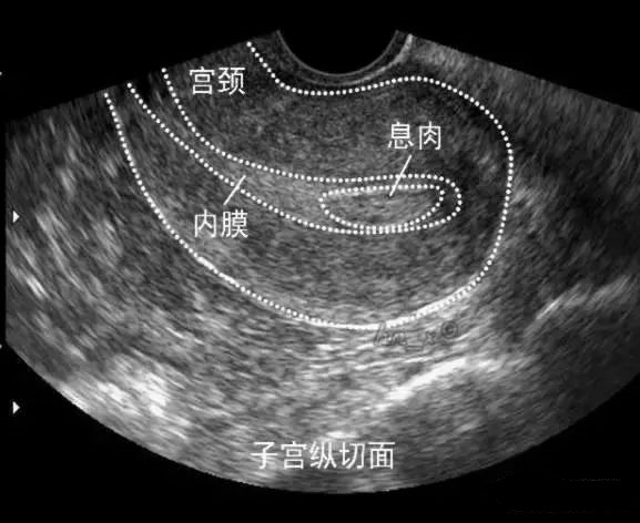 b超检查内膜回声不均是怎么回事,b超子宫内膜回声不均是怎么回事