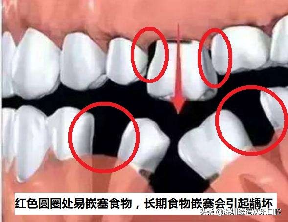 牙齿小洞你不瞅，变成大洞愁上愁