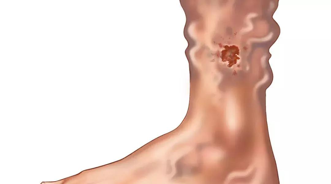 腿上有蚯蚓纹怎么回事,腿上出现蚯蚓似的纹路是怎么回事