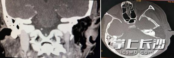 癌症晚期耳朵流脓,耳朵里长肿瘤而且流血流脓