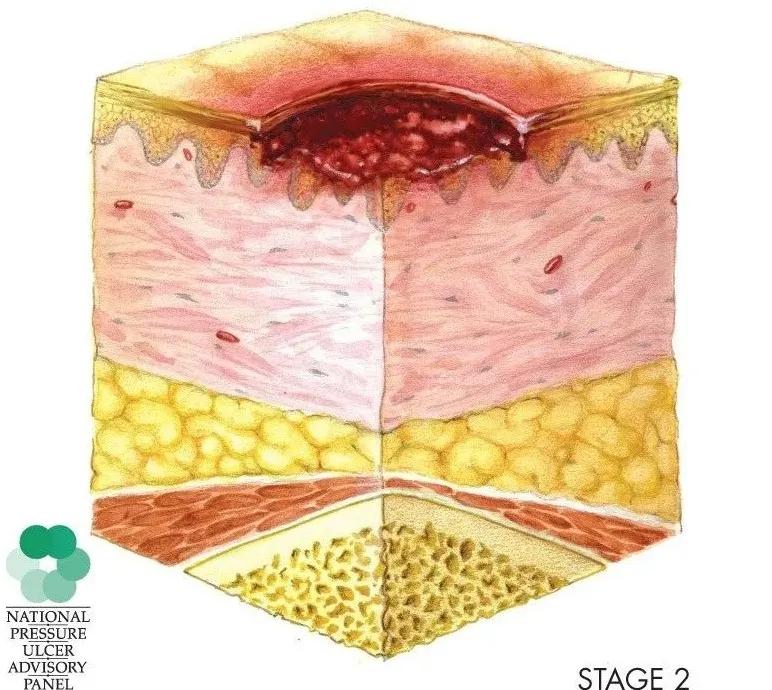 压疮情况要分期,严重危害需知道