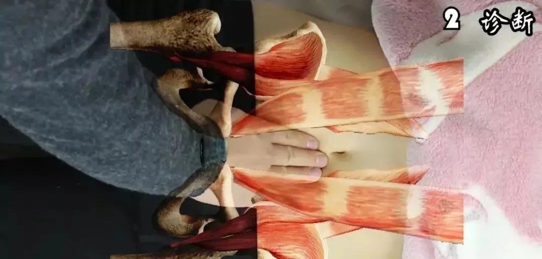 怎么确定是不是腹直肌分离,腹直肌分离到底是怎样的