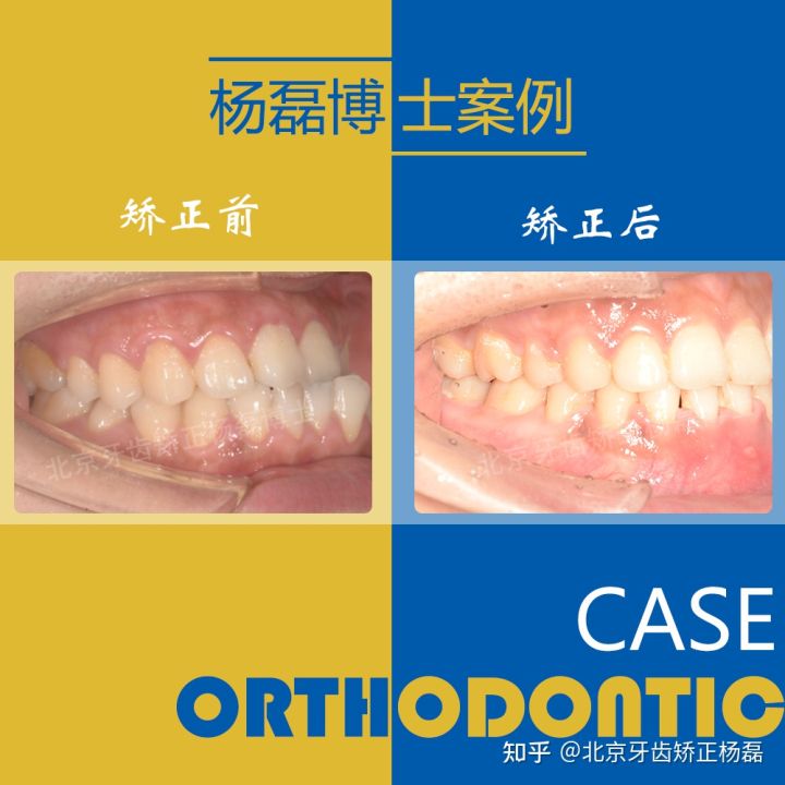 北京牙齿矫正大约要多少钱,北京哪个医院看牙齿矫正比较好