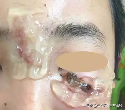 芦荟胶可以起到祛痘的作用吗,芦荟胶有什么作用能祛痘印吗