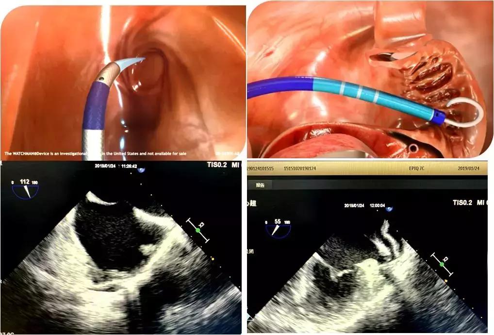 房颤与食道超声,经食管超声心动图能检查出房颤吗