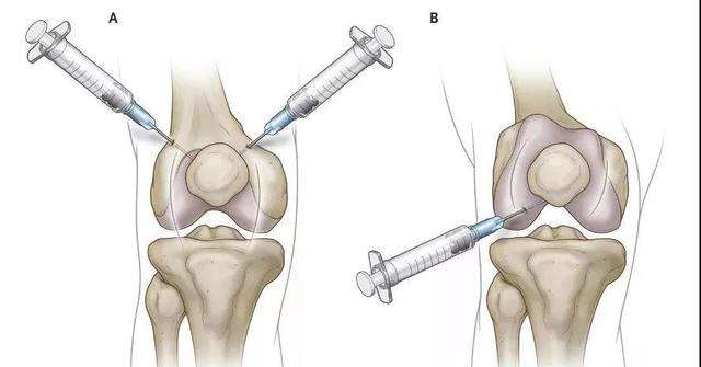 滑膜炎导致腿伸不直怎么治疗,腿伸不直也蹲不下去是什么原因