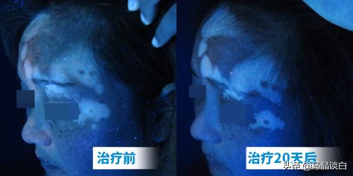 白癜风患者盲目用药的危害有哪些,白癜风不再发展是治好了吗