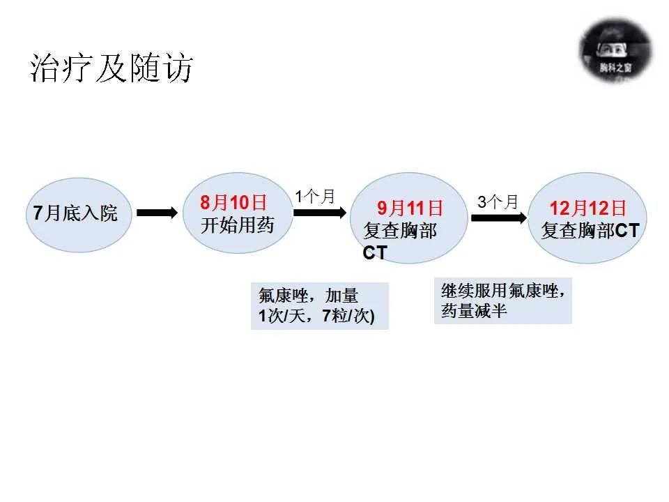 双肺多发结节是肺癌的征兆吗,双肺多发结节灶