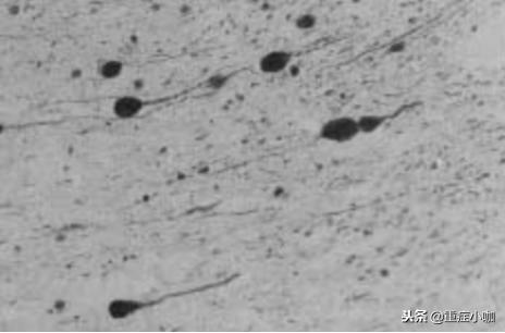 弥漫性轴索损伤和脑干挫伤,弥漫性轴索损伤有必要救吗