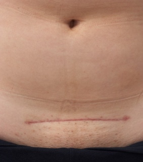 你真的了解女性结扎了吗,女性结扎还有其他方法吗