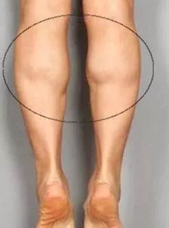 小腿大小不一样粗怎么改善,小腿粗外翻怎么改善