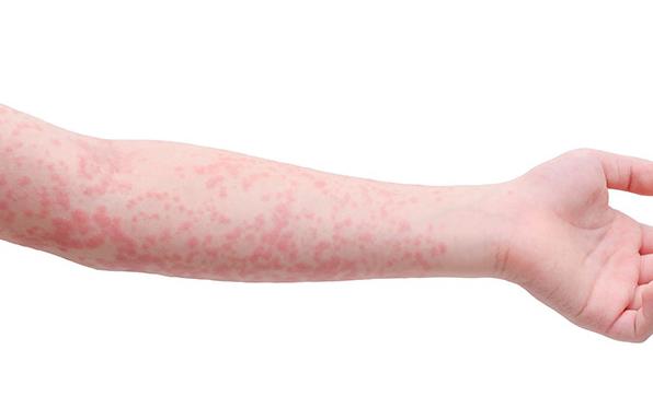 荨麻疹发病怎么缓解瘙痒症状,麻疹和荨麻疹的区别和治疗方法