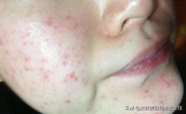 疮有什么症状怎么治,疱疹是怎么引起的