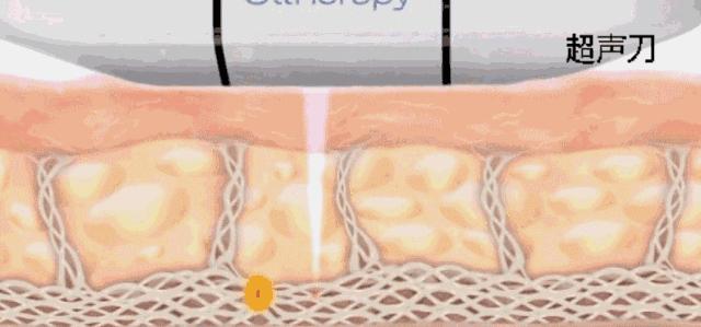 超声刀为什么一个月才能看到效果,超声刀真的会有效果吗