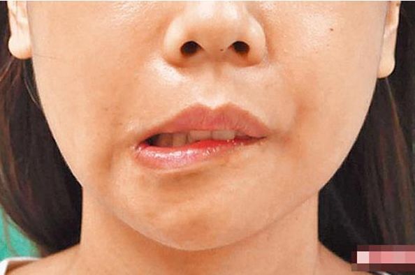 面瘫女孩针灸,儿童面瘫针灸治疗穴位