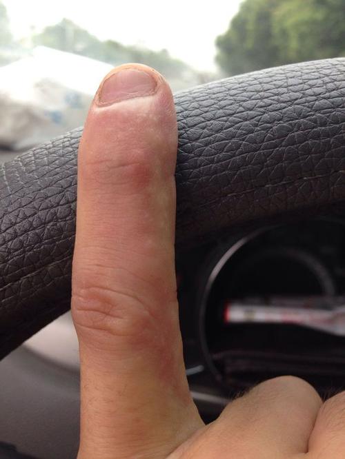 手干起皮像蛇皮一样怎么回事,手干燥起皮一定是手癣吗