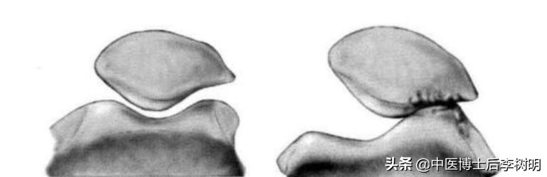 中医讲膝盖困痛是啥原因,弯曲膝盖髌骨疼是怎么回事