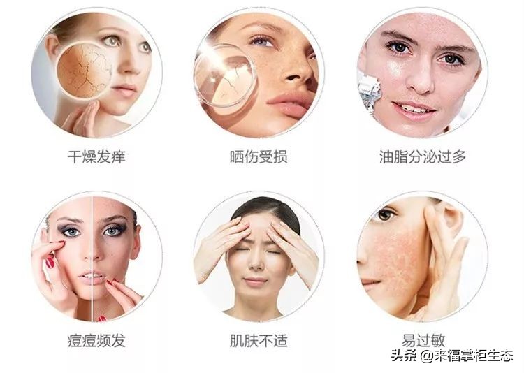 治疗湿疹,牛皮癣,婴儿孕妇都可以使用的面霜