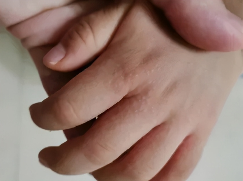 手上长一片小疙瘩还痒是怎么回事,天一热手上就起一层小疙瘩还很痒