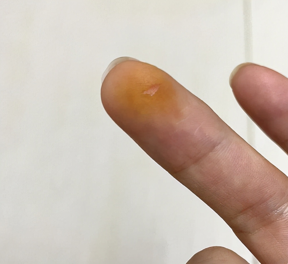 甲硝唑片可以治哪些妇科疾病,几块钱的甲硝唑栓有用吗