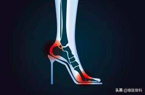 足底筋膜炎可以快走吗,足底筋膜炎快走