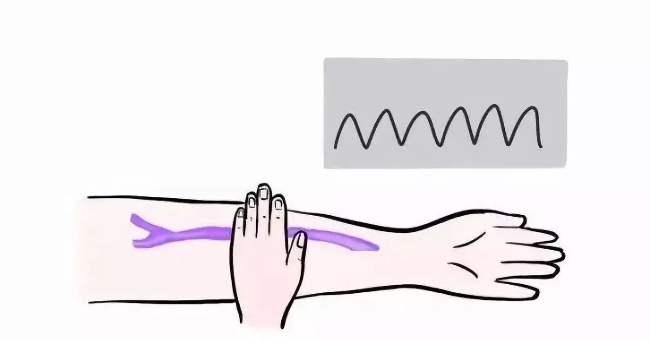 血透患者如何保护自己的“生命线”?做到这5点十分重要