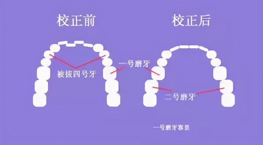 13岁儿童牙齿矫正龅牙前突,牙齿前突龅牙治疗过程