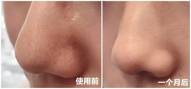 喷雾式的去黑头的东西,去黑头收缩毛孔吸黑头神器测评