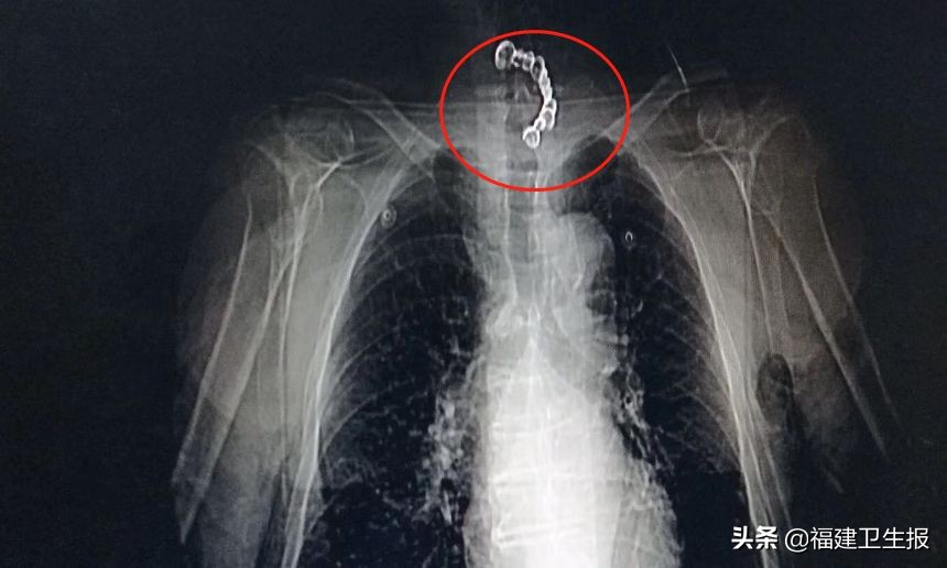 大爷误吞假牙8天后就医,大爷误吞假牙视频